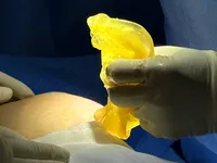Dissection Technique and LMA Anesthesia for Breast Implants: The Optimal Solution?