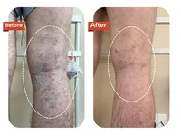 Foreign Tourist Recovers After Varicose Vein Treatment at Dr.Vein
