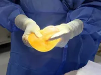A rare case of bilateral breast implants with different implant types