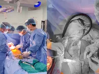 Vietnam performs first new-generation LVAD implant