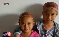 Cảm động hai em nhỏ tình nguyện hiến da đầu cứu cha