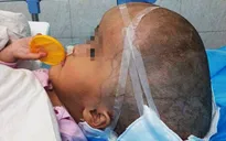 Trung Quốc: Bé gái bị não úng thủy đầu tiên trên thế giới được thay hộp sọ nhân tạo