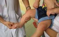 Bệnh tay chân miệng: Những điều cần biết