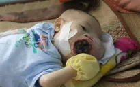 Sự sống mong manh của cháu bé 5 tháng tuổi bị u máu quai hàm