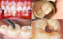 Anh: Sáng chế thiết bị giảm đau khi chữa răng
