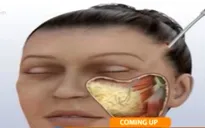 Có nên căng da mặt?