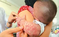 Cách phòng chống bệnh sởi trong mùa Đông Xuân