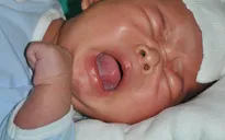 Xót thương bé 44 ngày tuổi bị bỏng than