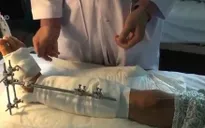 Ghép nối thành công bệnh nhân bị máy cắt cỏ chém đứt chân