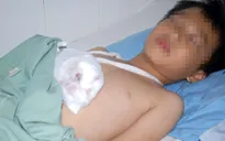 Lâm Đồng: Nổ sạc đèn pin, bé 8 tuổi dập nát bàn tay