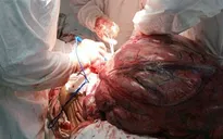 Phẫu thuật thành công khối bướu nặng 26 kg trong bụng một phụ nữ