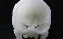 Công nghệ in 3D giúp phẫu thuật u não thành công