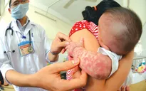 Cách chăm sóc trẻ bị sốt phát ban