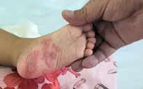 Tăng cường phòng chống sốt xuất huyết và tay chân miệng