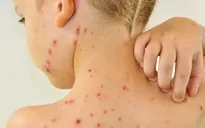 Bệnh thuỷ đậu đang vào mùa tại phía Nam