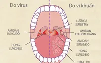 Kháng sinh không phải phao cứu sinh với bệnh viêm họng virus