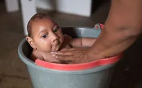 Virus Zika có thể gây chứng rối loạn thần kinh nghiêm trọng
