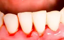 Bệnh nha chu làm tăng nguy cơ ung thư vú