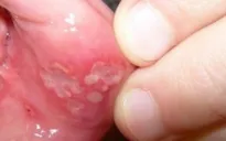 Phương pháp hữu hiệu chữa bệnh nhiệt miệng tại nhà