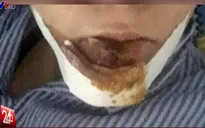 Thanh tra việc nạn nhân phải cắt bỏ môi do biến chứng sau phẫu thuật thẩm mỹ