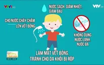 Cách sơ cứu khi trẻ bị bỏng nước sôi