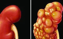 Ung thư thận có xu hướng gia tăng và ngày càng trẻ hóa