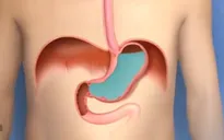 Trào ngược dạ dày thực quản: Nhận biết qua dấu hiệu nào?
