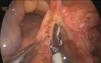 Mắc ung thư dạ dày vì những thói quen tưởng như bình thường