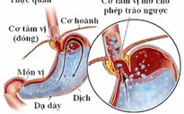 Tìm hiểu về bệnh trào ngược dạ dày - thực quản