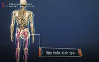 Điều trị bệnh đau dây thần kinh tọa bằng Đông y
