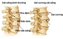 Điều trị bệnh gai cột sống bằng vật lý trị liệu