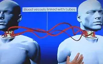 Bệnh viện Việt Đức tìm người sẵn sàng ghép đầu