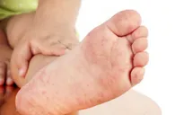Cách nhận biết sớm và chăm sóc đúng cách trẻ mắc tay chân miệng