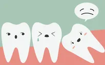 Những phiền toái từ chiếc răng "khôn" nhưng mọc "dại"