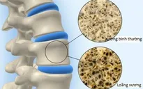 Loãng xương, thoái hóa khớp không còn là 'bệnh của người già'