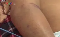 Cách phòng tránh nhiễm khuẩn liên cầu lợn
