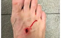 Luis Suarez lại ghi dấu ấn lên cơ thể đối phương