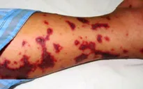 Sự nguy hiểm của bệnh viêm màng não mủ do mô cầu