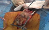 Phẫu thuật cứu bệnh nhân có khối u 7kg trong lồng ngực