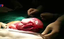 Mổ thành công khối u gan lớn nhất cho trẻ sơ sinh