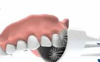 Glaresmile – Bàn chải làm sạch răng trong 10 giây