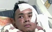 Colombia: Sống sót ngoạn mục sau khi bị đâm xuyên mắt thủng não