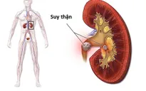 Ba phương pháp điều trị bệnh suy thận mãn tính