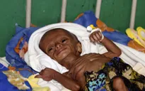 Gần 2,2 triệu trẻ em Yemen bị suy dinh dưỡng nặng