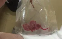 Hà Nội: Tạm đình chỉ bác sĩ quên gạc sau phẫu thuật