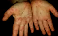 Cách chăm sóc trẻ trước dịch tay chân miệng