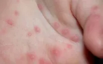 Bệnh tay chân miệng diễn biến phức tạp tại Bạc Liêu