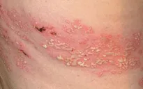 Cảnh báo tự mua thuốc điều trị bệnh Zona thần kinh tại nhà