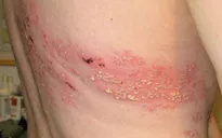 Phương pháp phòng ngừa, điều trị đúng cách bệnh Zona