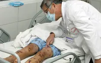 Hà Nội ghi nhận ca viêm não mô cầu đầu tiên năm 2016